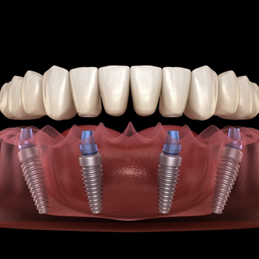 Illustration of dentures being attached to dental implants for All-on-4 in Waldorf, MD