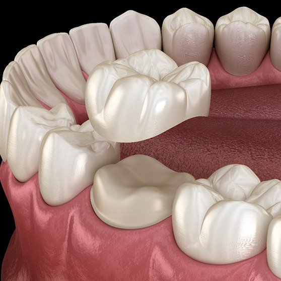 A 3D illustration of placed dental crowns in Inver Grove Heights