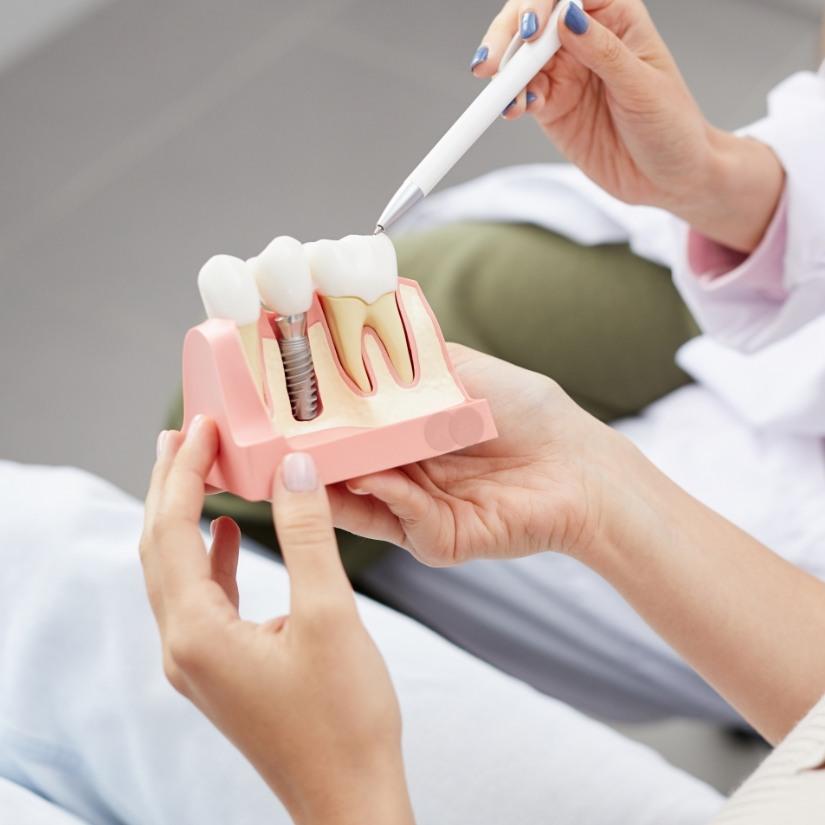 Dentist using smile model to explain the four step dental implant process