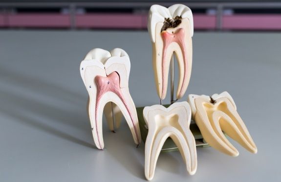 Model of healthy tooth compared to tooth in need of root canal treatment
