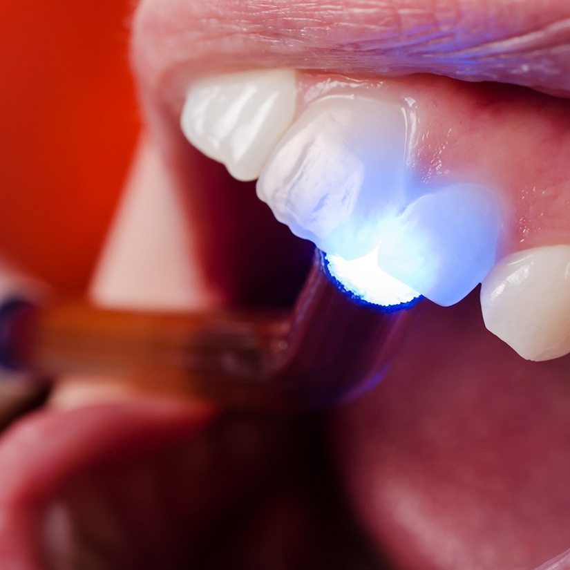 Dental light hardening tooth-colored filling