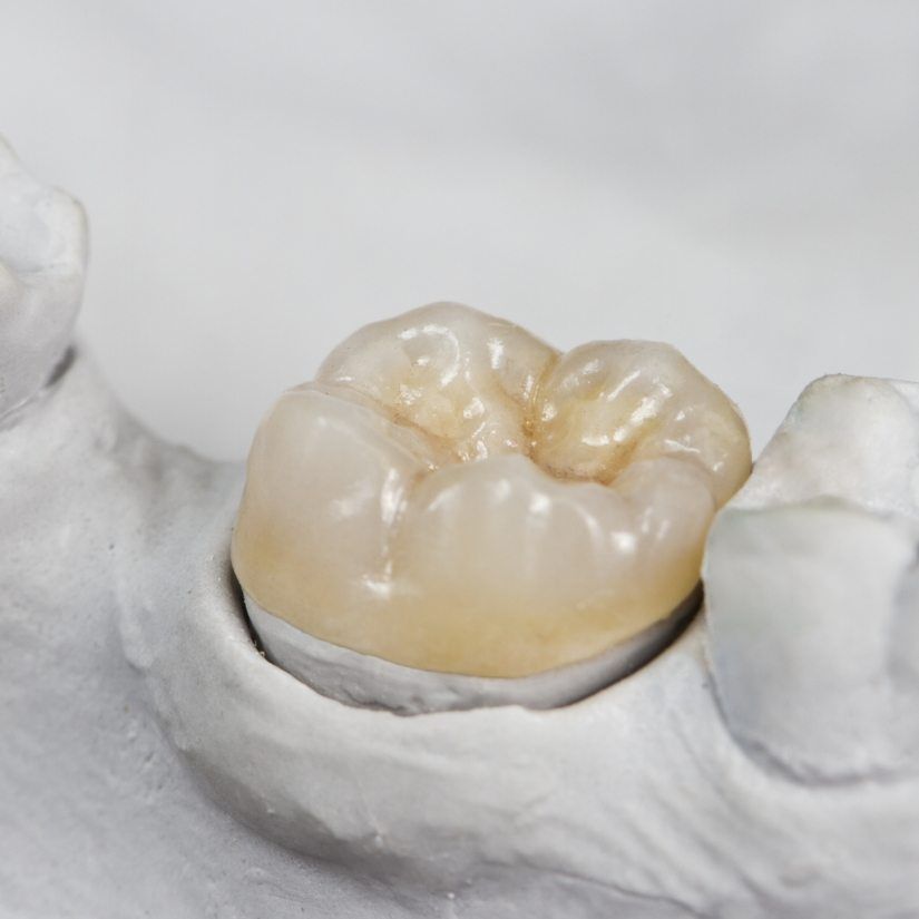 Model smile with dental restoration