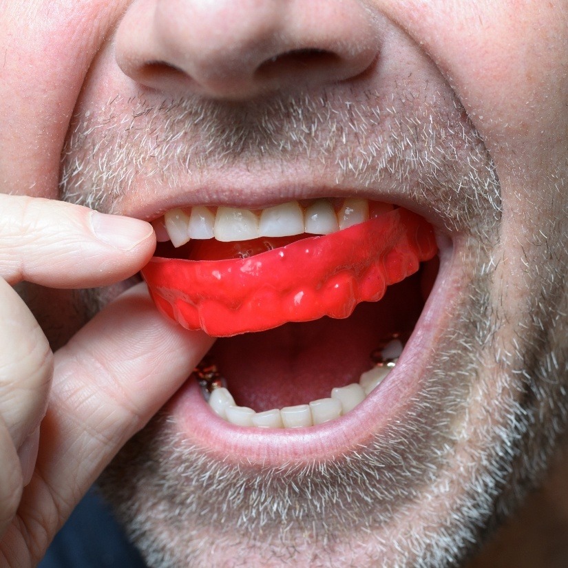 Closeup of dental patient placing an athletic mouthguard