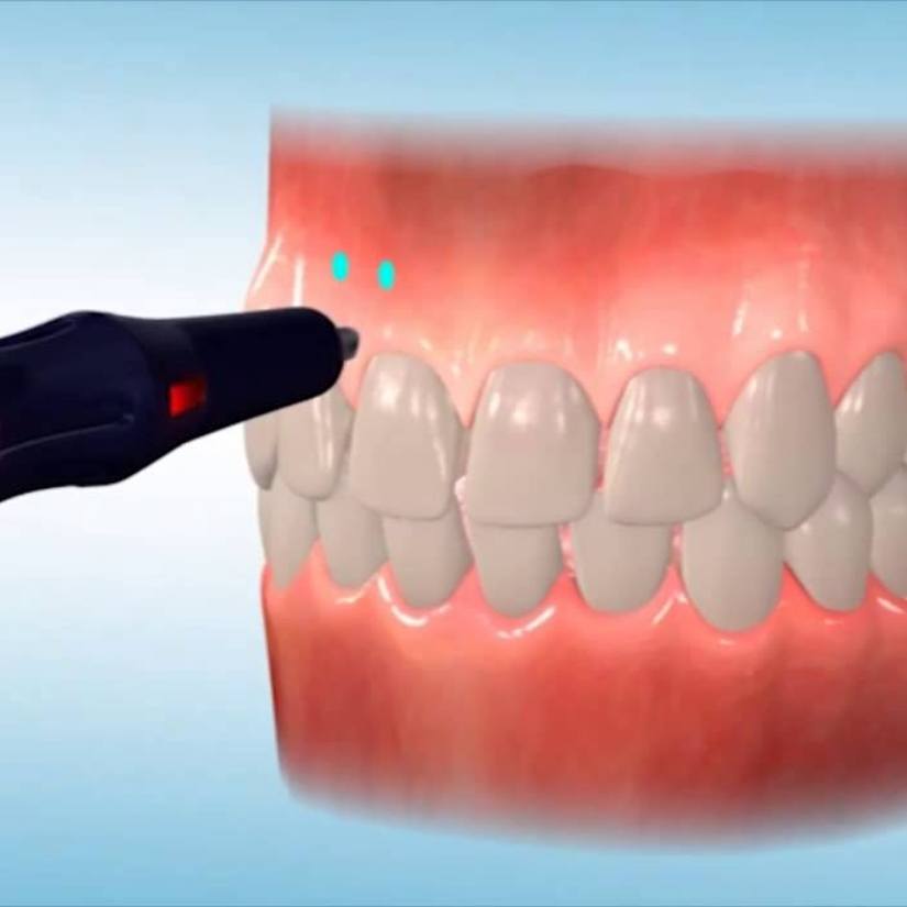 Animated smile receiving Propel accelerated orthodontic treatment