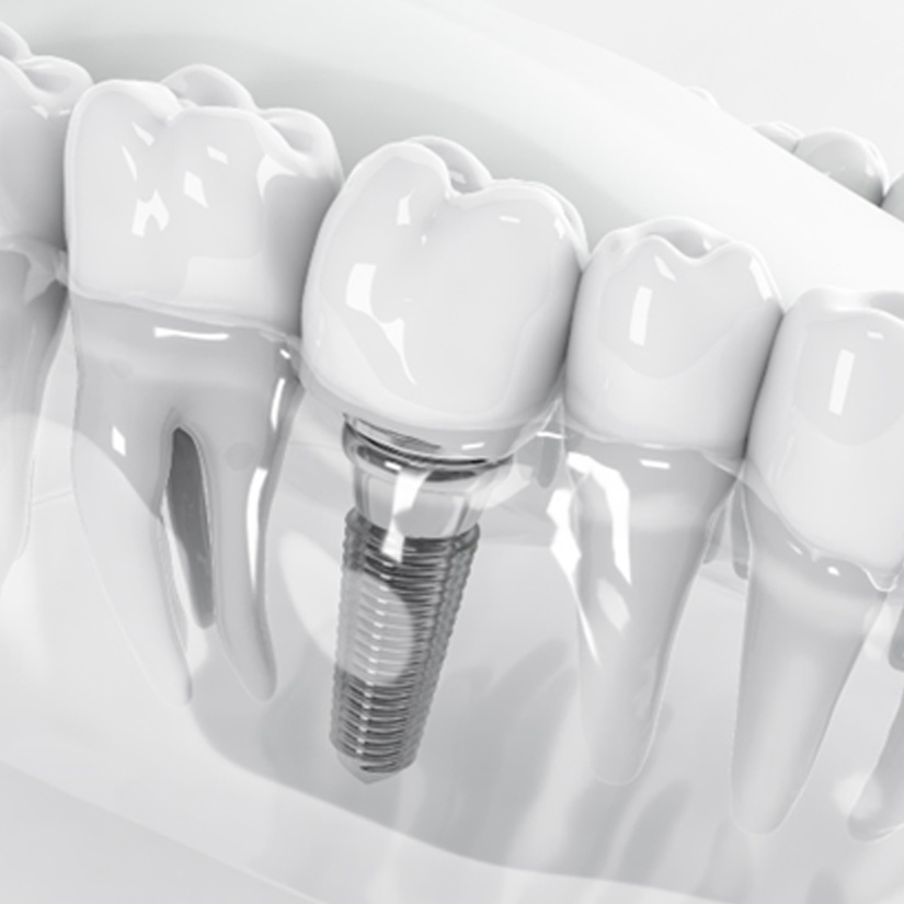 : an example of a dental implant in Waldorf