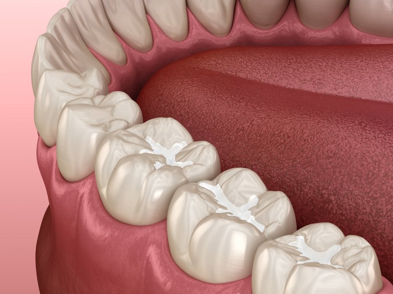 3D render of a filled tooth